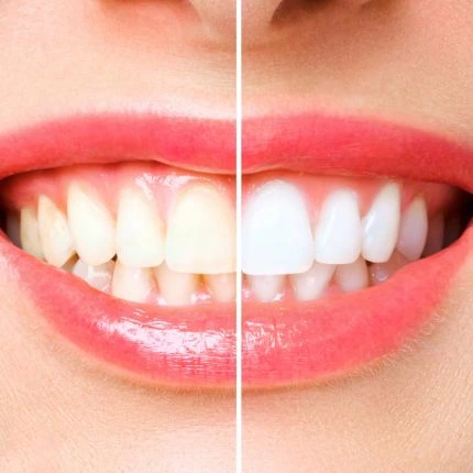 Comparação ilustrativa entre diferentes tonalidades de dentes