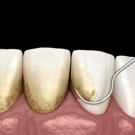 Ilustração de instrumento periodontal junto a dentes com acúmulo de tártaro