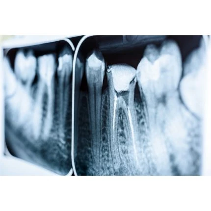 Imagem radiográfica ilustrativa de um dente com tratamento de canal